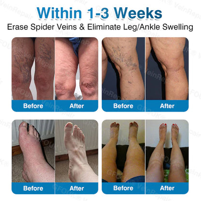 US✅🌱 VeinRepair Microneedle Patch Roll⚡Instant Relief, Long-Term Results