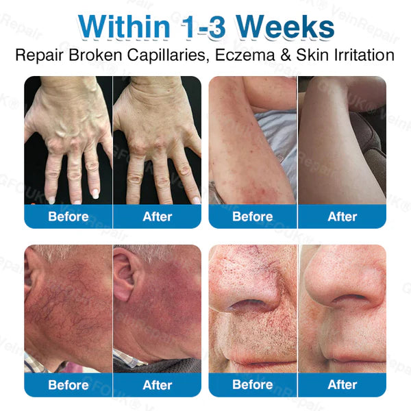 US✅🌱 VeinRepair Microneedle Patch Roll⚡Instant Relief, Long-Term Results