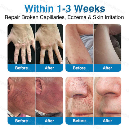 US✅🌱 VeinRepair Microneedle Patch Roll⚡Instant Relief, Long-Term Results