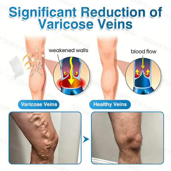 US✅🌱 VeinRepair Microneedle Patch Roll⚡Instant Relief, Long-Term Results