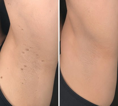 🌟 2-in-1 Microneedle & Hydrocolloid Patch 🌿 Invisible Face & Body Patches for Raised Moles, Acne, Flat Warts & Skin Tags - Helps Improve the Appearance of Wrinkles, Scars & Blemishes