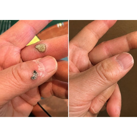 🌟 2-in-1 Microneedle & Hydrocolloid Patch 🌿 Invisible Face & Body Patches for Raised Moles, Acne, Flat Warts & Skin Tags - Helps Improve the Appearance of Wrinkles, Scars & Blemishes